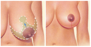 breast-reduction