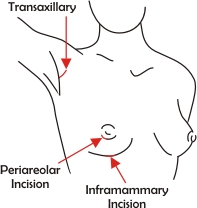 breast_incisions