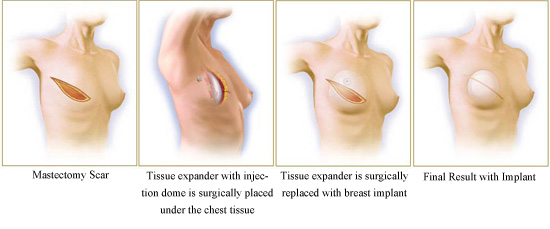 tissue_expander